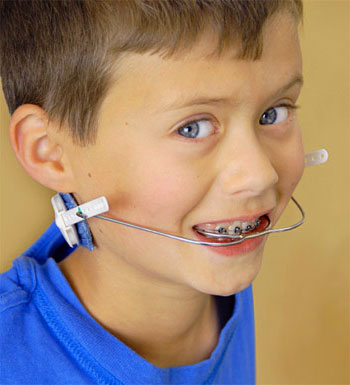 Headgear for Braces in Children