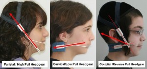 Uses of Orthodontic Headgear With Braces - Headgear Braces
