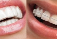 Ceramic Braces or Invisible braces, Which is better?