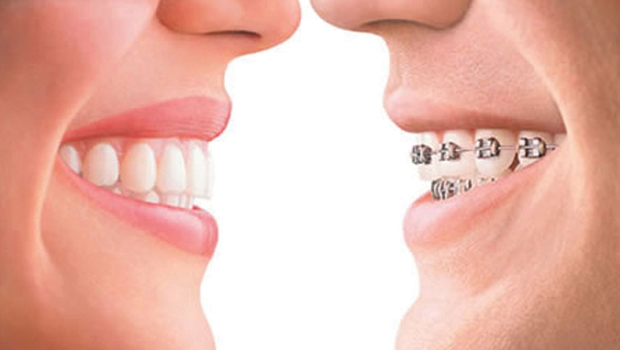 Invisalign Vs Braces Cost And Benefits Headgear Braces 