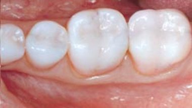 Dental Amalgam Fillings or Resin composite