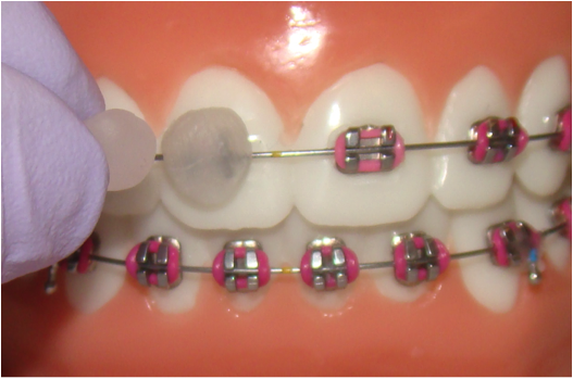 How to Put Wax on braces