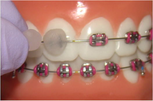 How to Put Wax on braces - Headgear Braces