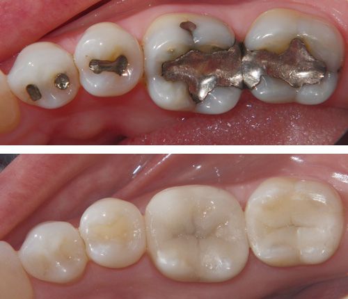 Silver Fillings versus White Teeth Fillings
