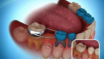 Space Maintainers Types used in Pediatric Dentistry