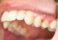 Periodontal disease Cure, Causes and Signs