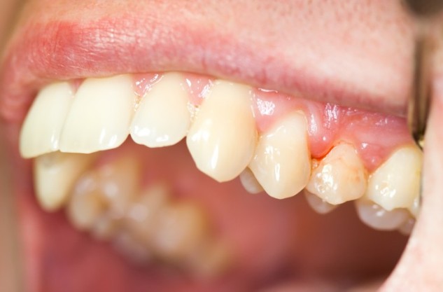 Periodontal disease Cure, Causes and Signs
