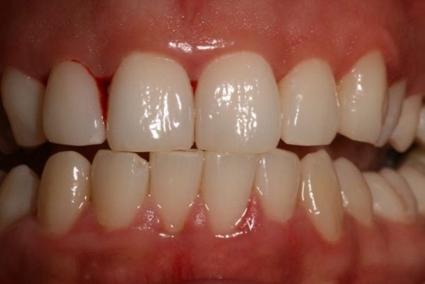 Sore Gums: Causes, Symptoms and Treatment