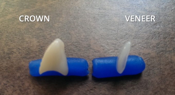 Veneers vs Crowns: Cost and Durability