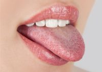 White Coated Tongue and Oral Thrush