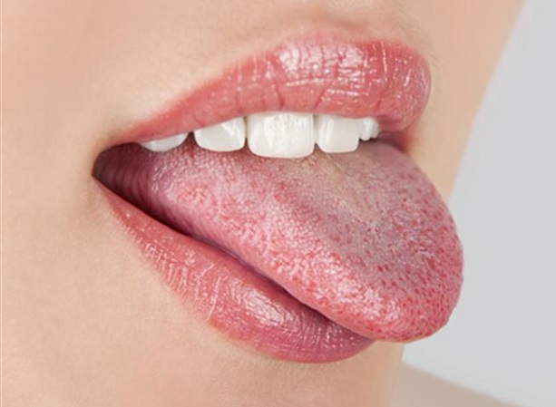 oral thrush tongue