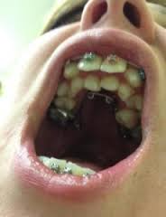 Hyperdontia (Extra Teeth) Causes, Treatment and Removal