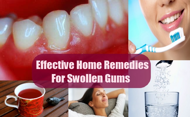 sore-inflamed-gums-pain-relief-home-remedies-headgear-braces