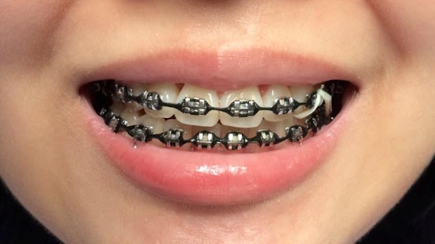 Braces: Pink, Purple, Black, Blue! What colors look best? - Headgear Braces