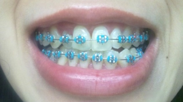 Braces: Pink, Purple, Black, Blue! What colors look best? - Headgear Braces