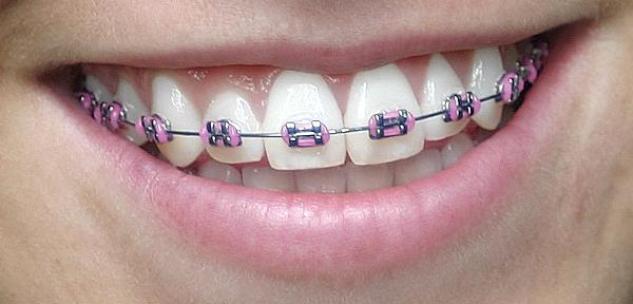 Pink Braces Color Pictures