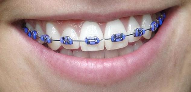 Braces Pink Purple Black Blue What Colors Look Best Headgear Braces 