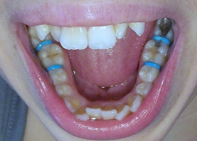 spacers-for-braces-teeth-separators-uses-pain-relief-foods-to-eat