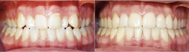 What is Crossbite?