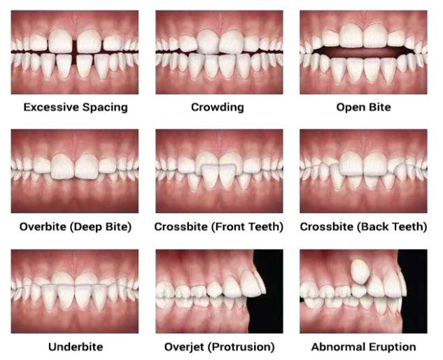 What is Overbite, Underbite, Openbite, Crossbite in Orthodontics
