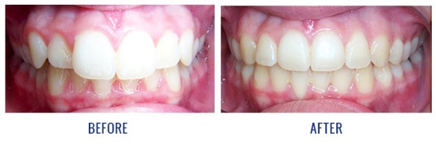 What is Overbite?