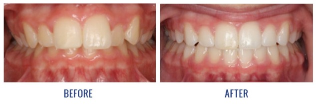 What is Underbite?