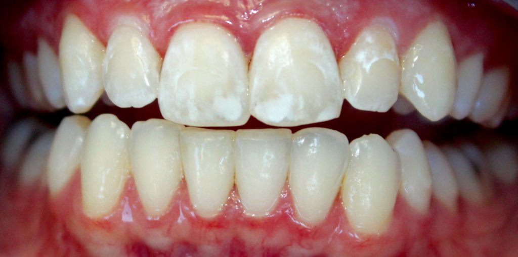 White Spots on Teeth after Braces treatment Headgear Braces