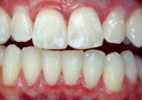 White Spots on Teeth after Braces treatment