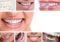How much do Braces cost with/without Insurance