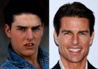 Tom Cruise teeth and Smile Before and After Braces
