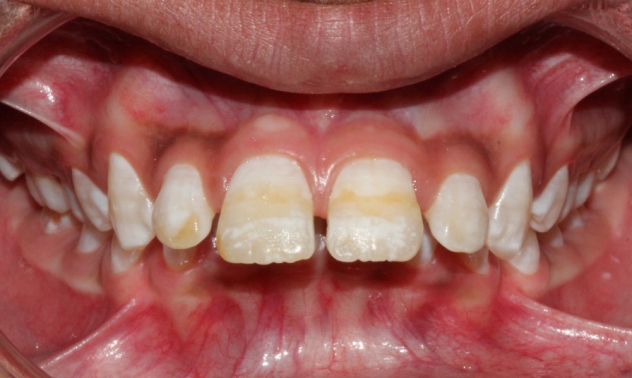 buck teeth pictures symptoms and treatment