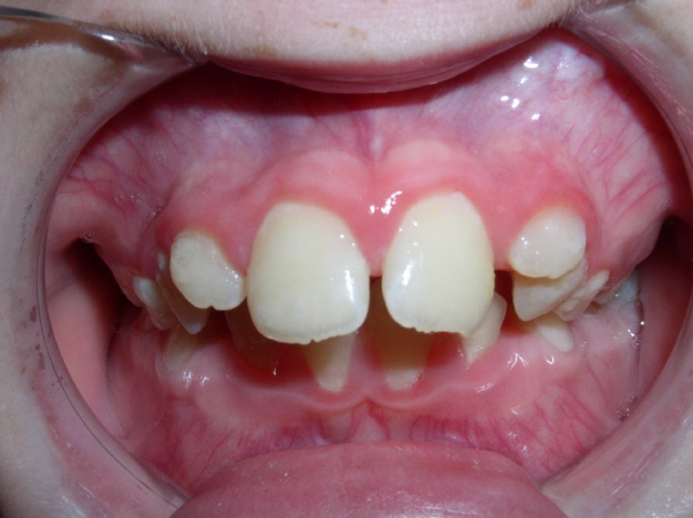 Buck Teeth Pictures, Symptoms and Treatment