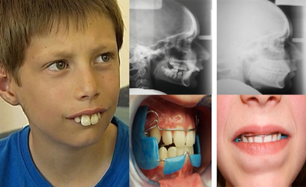 buck-teeth-pictures-symptoms-and-treatment