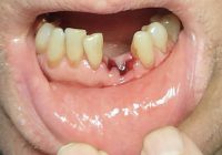 Dry Sockets Symptoms, Treatment after Tooth Extraction