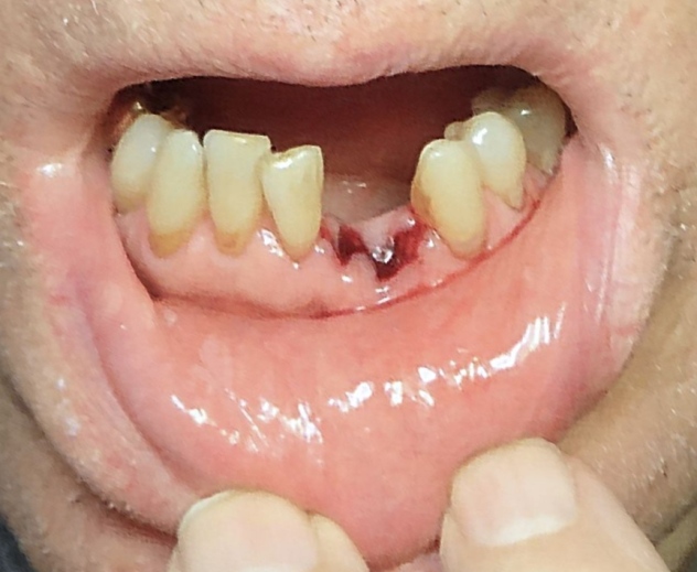 Dry Sockets Symptoms, Treatment after Tooth Extraction