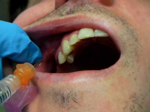 dry sockets after tooth extraction
