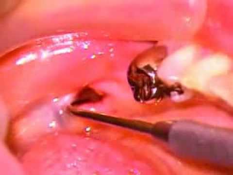 dry sockets after tooth extraction