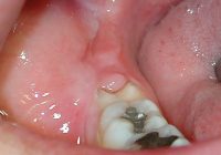 Pericoronitis (Wisdom Tooth Infection Pain) Treatment at home