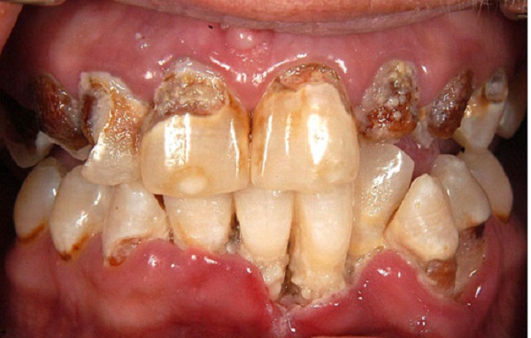 rotten teeth