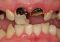 Rotten Teeth and Tooth Decay