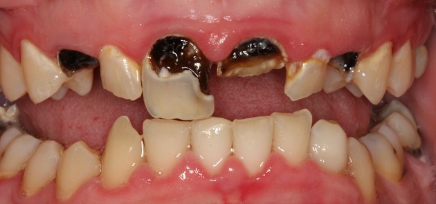 Rotten Teeth and Tooth Decay - Headgear Braces