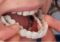Snap-On Smile Reviews: Cost, Advantages, Problems