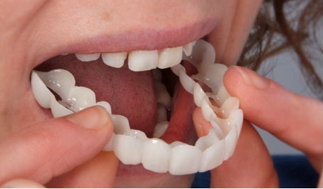 Snap-On Smile Reviews: Cost, Advantages, Problems