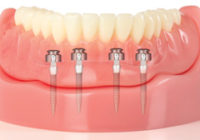 Mini Dental Implants Cost & Prices Paid