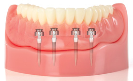 Mini Dental Implants Cost & Prices Paid