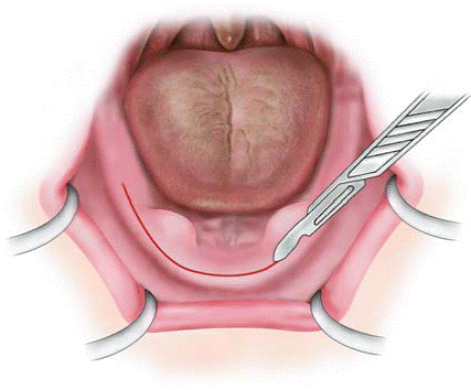 tori removal surgery torus causes dental mandibularis cost